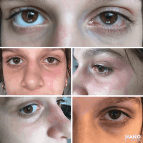 before and after eye injury remedy