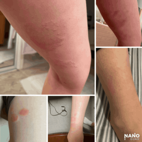 natural rash remedy before and after