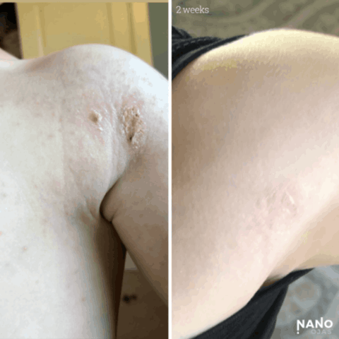 before and after metadichol for shoulder skin