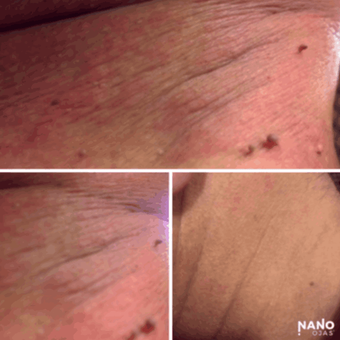 before and after skin tag homeopathic remedy