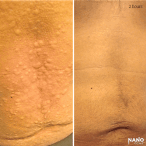 skin lump before and after nanotechnology