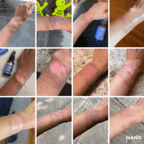 deep burn homeopathic remedy before and after