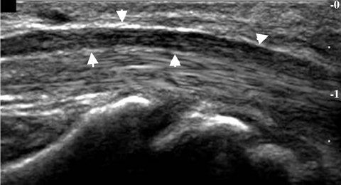 Corte longitudinal del nervio mediano, que muestra un patrón «fascicular» con fibras continuas y largas, relativamente hipoecóicas, con un borde hiperecoico que corresponde al epineuro.