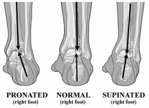 Do you pronate, supinate, or have a neutral foot condition? 