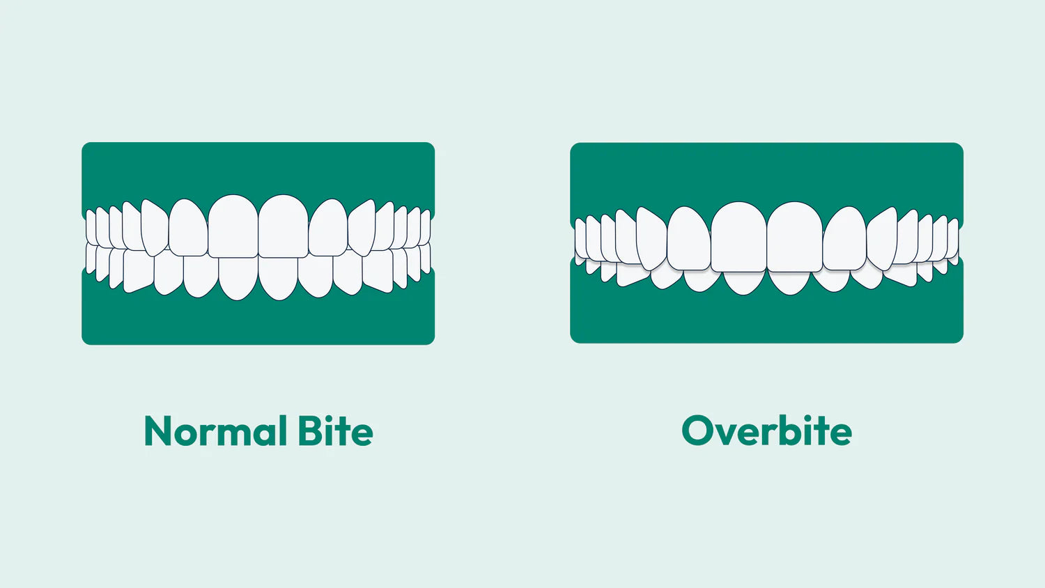 A person with huge gap in front teeth (incisors)