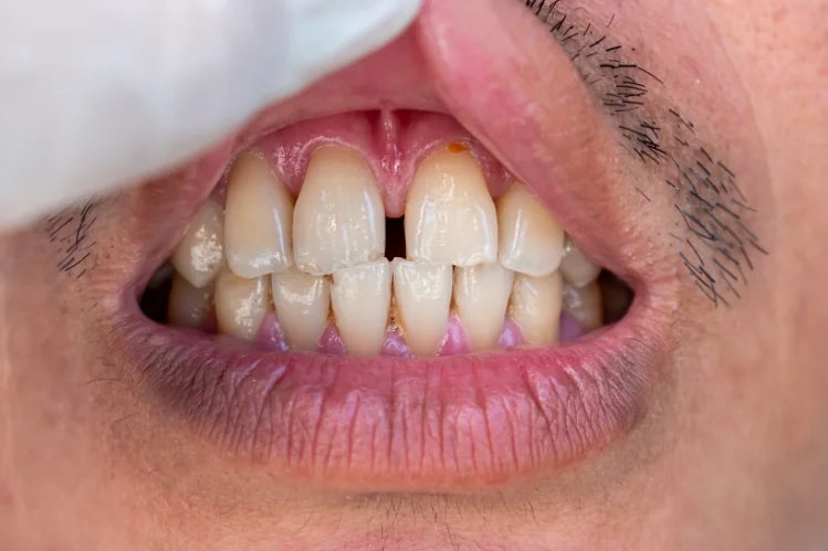 Underbite treatment