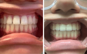 Gap in Front Teeth