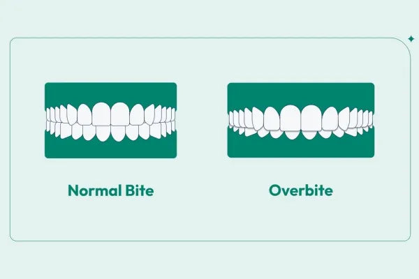 Side by side image of an overbite and a normal bite