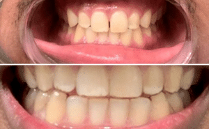 Gap in Front Teeth