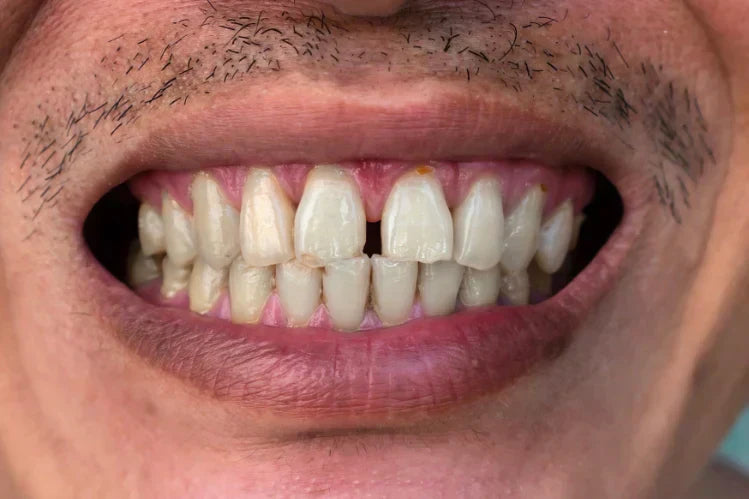 Underbite treatment