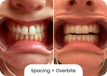 Overbite