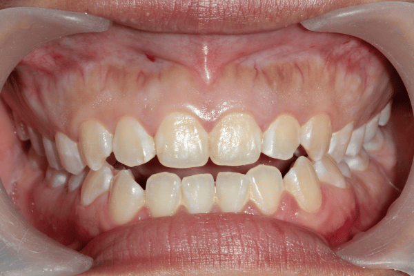 Anterior open bite