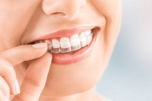 Beautiful smile with clear aligners