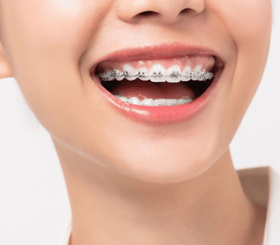 Braces Cost in Sydney: Exploring Affordable Teeth Straightening