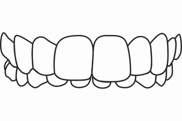 Illustration of an overbite
