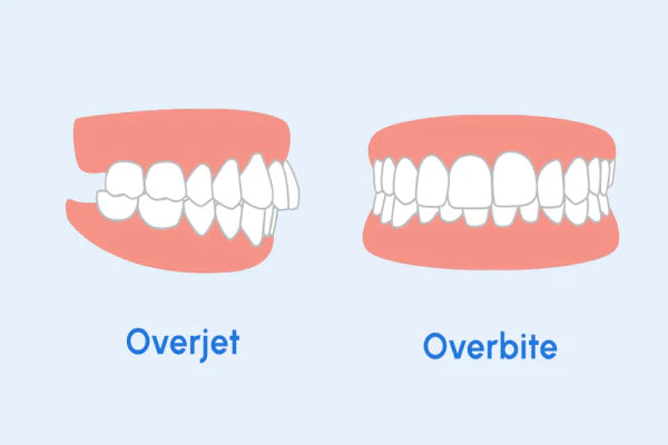 Underbite treatment