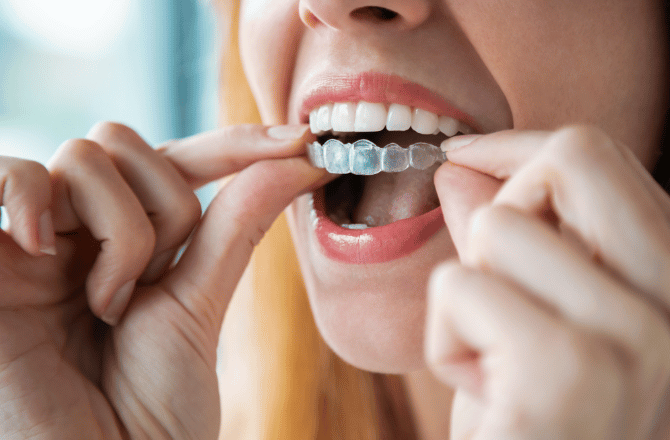 Do Clear Braces Work? Everything to Know for New Users