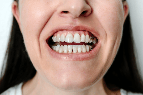 attachments on teeth