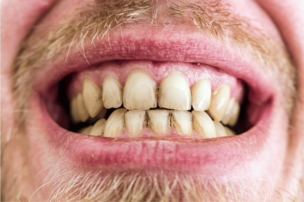 smoker’s yellow teeth