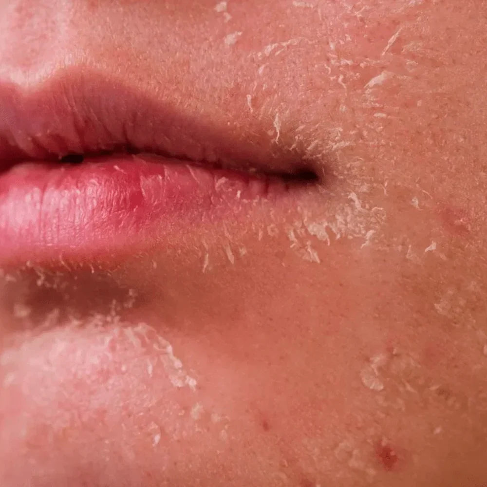 Helps_with_Dryness_dehydration-min.webp__PID:a94ca240-a5c8-45e9-8b66-e4b29e8ae310