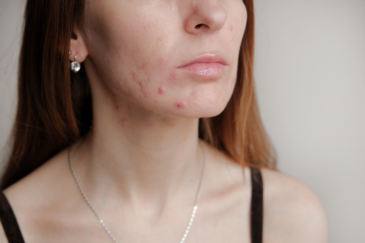 a lady showing acne on cheeks