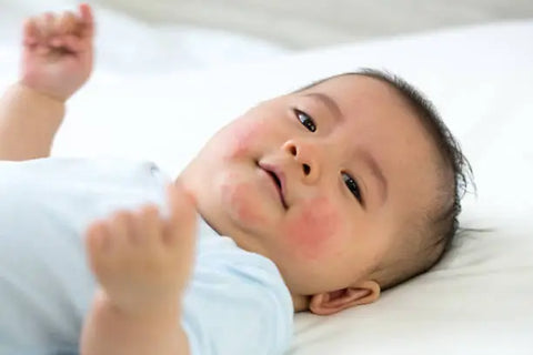 another baby having allergic reaction