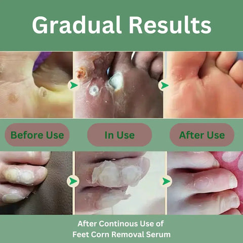 Gradual Results of Feet Corn Removal Serum