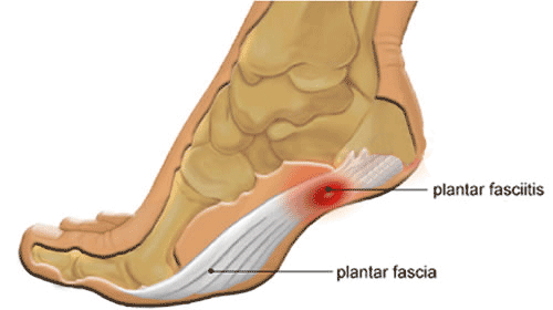 Plantar Fasciitis