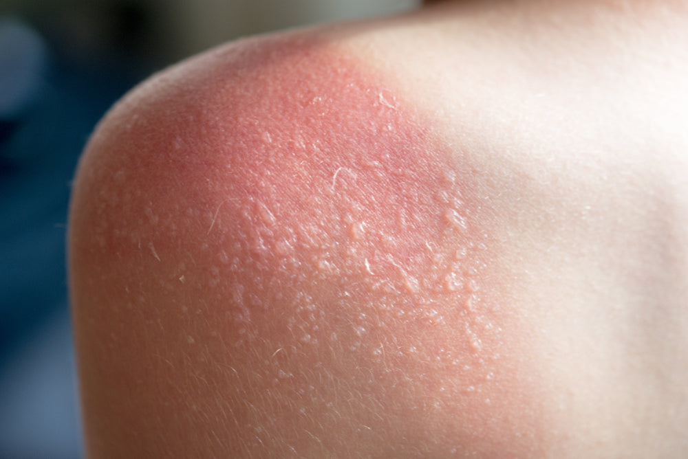 Common Types of Skin Damage by the Sun