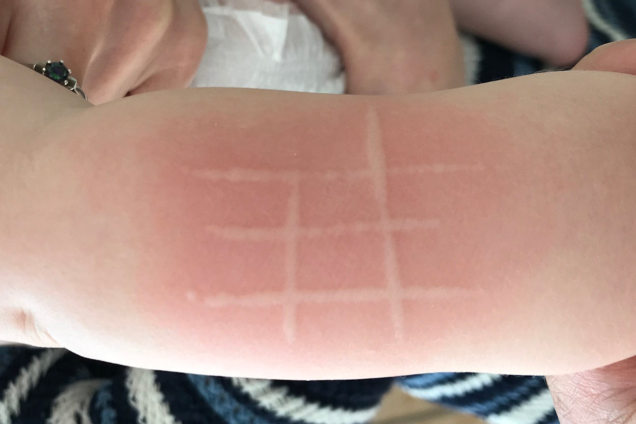 An example of dermatographia