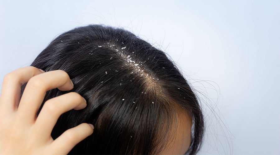 dandruff example of sensitive scalp causes