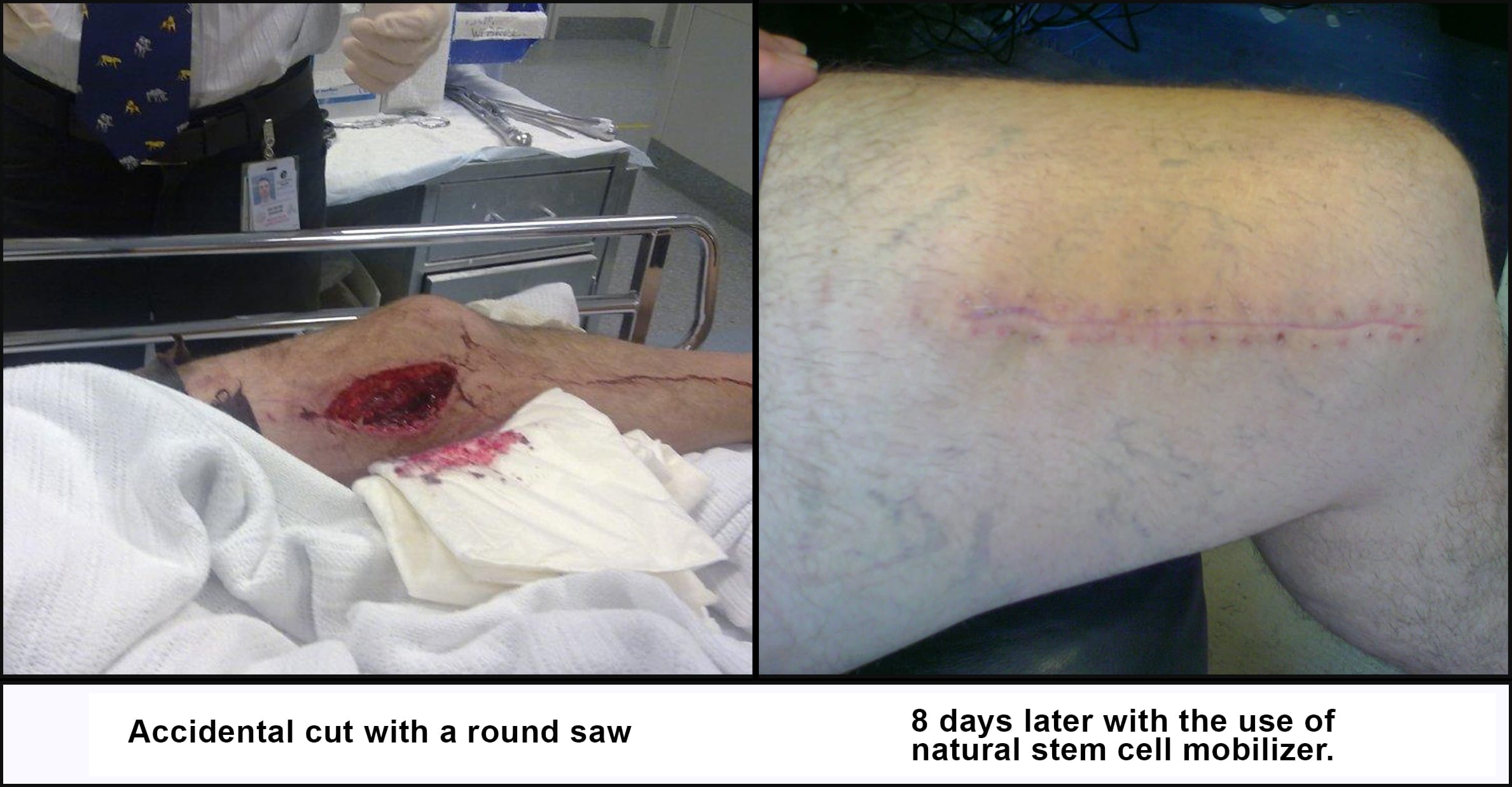 stem-cell-wound-healing