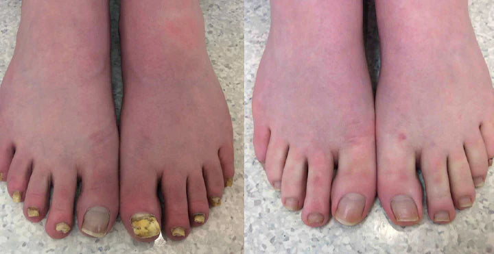 Antes e Depois BeeVenom