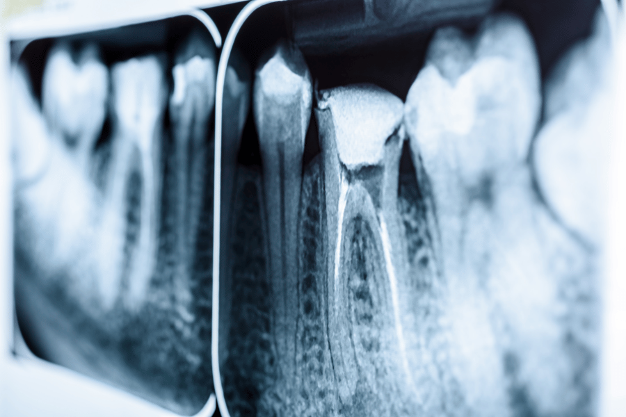 Teeth Straightening 
