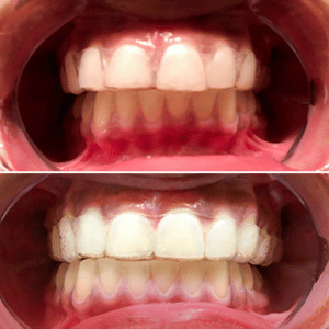 Case of overjet