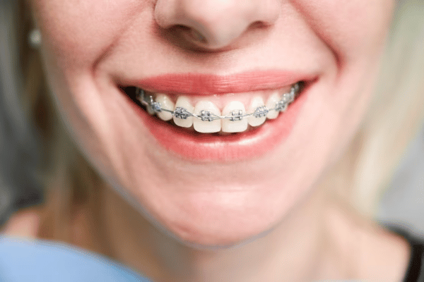 traditional braces 