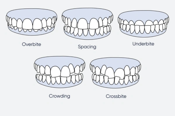 An image representing the cases that clear aligners can treat