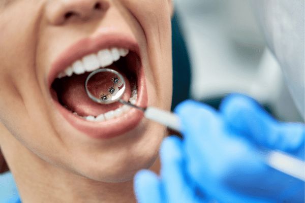  Lingual braces for correcting dental misalignment issues 