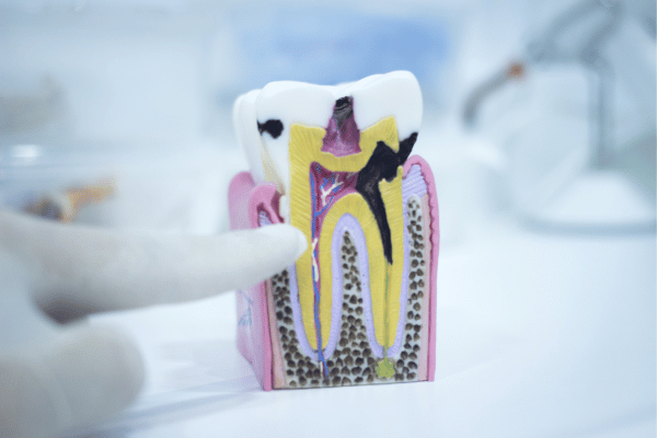 tooth decay