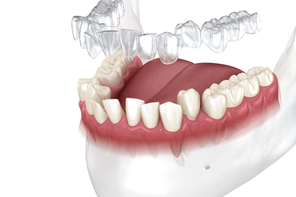 Clear aligners treatment