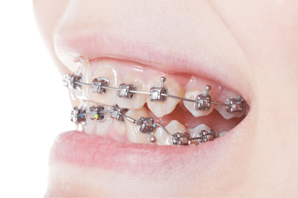 Metal braces