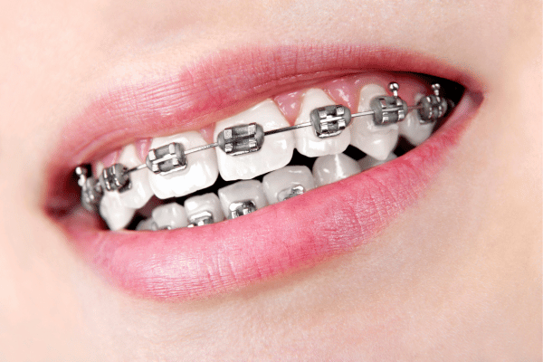 Traditional metal braces