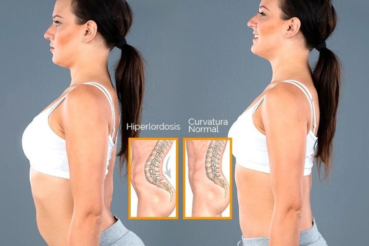 A imagem mostra duas mulheres: uma com hiperlordose, com a lombar projetada pra frente, e outra com a coluna reta, normal.