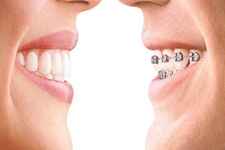 An illustration describes teeth aligners vs traditional braces