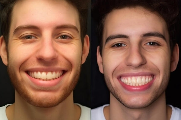 Before and after of a man with straightened teeth