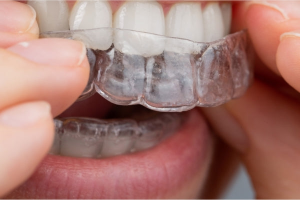 clear aligners