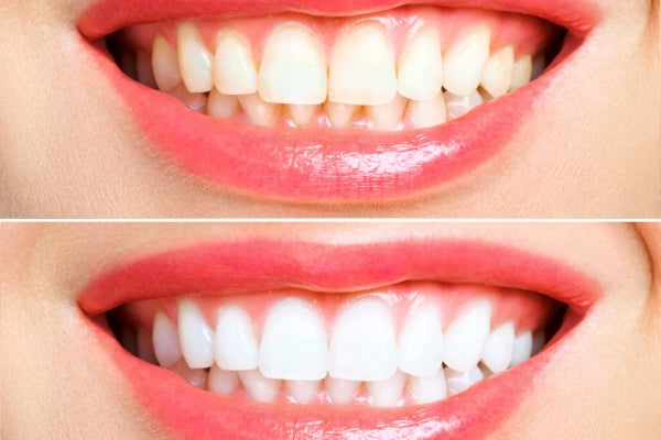  teeth whitening before and after