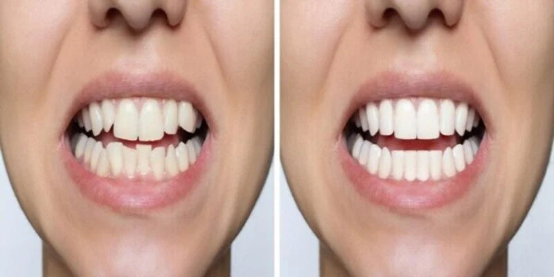 Before and After of teeth