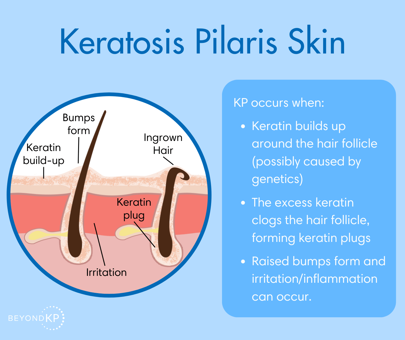 Keratosis Pilaris Skin Infographic - BeyondKP