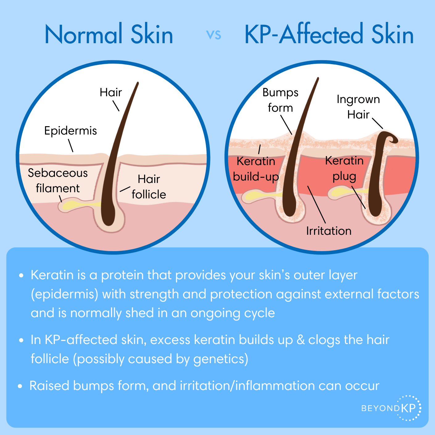 Keratosis Pilaris vs Normal Skin Infographic - BeyondKP